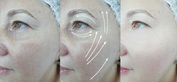 elderly woman face wrinkles before and after treatment arrow