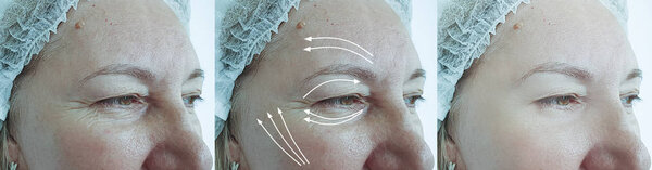 elderly woman face wrinkles before and after treatment arrow
