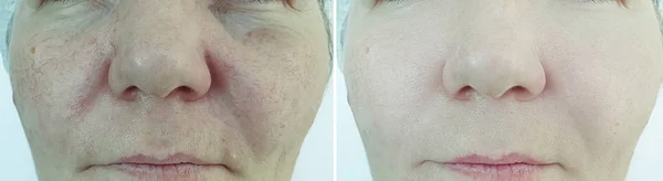 Ältere Frau Gesicht Falten Vor Und Nach Der Behandlung — Stockfoto