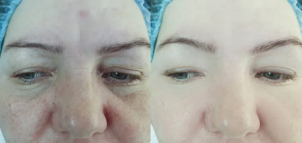 Arrugas Cara Mujer Mayor Antes Después Del Tratamiento — Foto de Stock
