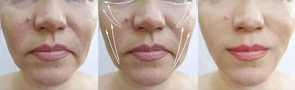 Arrugas Cara Mujer Antes Después Del Tratamiento Flecha —  Fotos de Stock