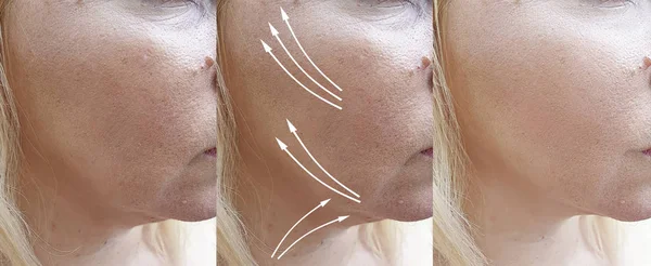 Woman Face Wrinkles Treatment Arrow — Stock Photo, Image