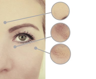 Kadın tedavi öncesi ve sonrası kırışıklıklarla karşılaşır.