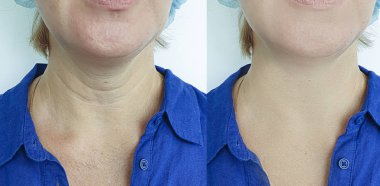 kadın kırışıklıkları yüz işlemden önce ve sonra