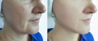 kadın kırışıklıkları yüz işlemden önce ve sonra