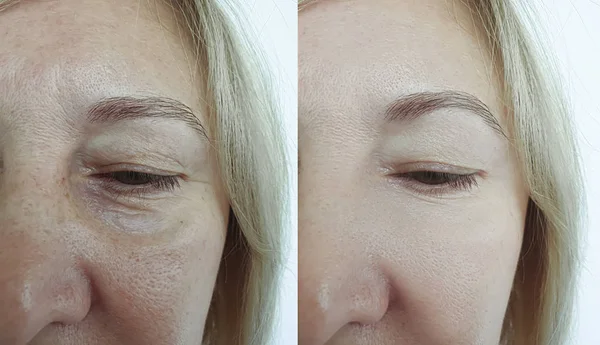 Arrugas Cara Mujer Antes Después Del Tratamiento Collage — Foto de Stock