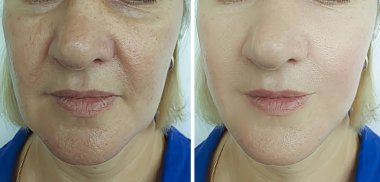 Kadın tedavi öncesi ve sonrası kırışıklıklarla karşı karşıya.