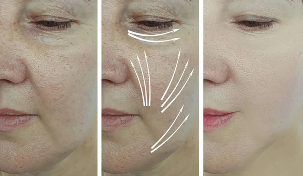 Arrugas Cara Mujer Antes Después Del Tratamiento Flecha — Foto de Stock