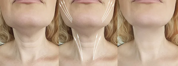 治療前と治療後の女性の顔のしわ持ち上げ — ストック写真