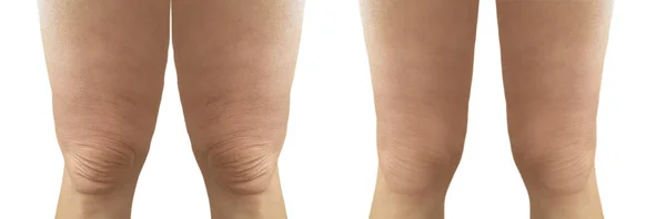 Cellulit Kobiece Nogi Przed Utracie Wagi — Zdjęcie stockowe