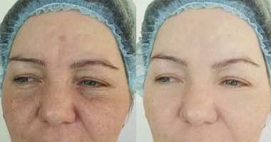 Rosacea tedavisinden önce ve sonra kırışık kadın yüzü