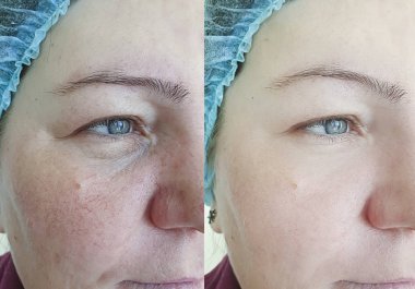 Rosacea tedavisinden önce ve sonra kırışık kadın yüzü