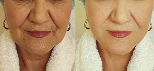 治疗前后的老年妇女皱纹的脸 — 图库照片