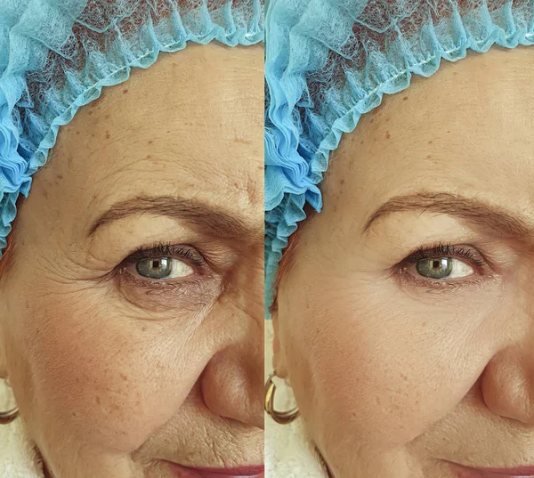 Ηλικιωμένη Γυναίκα Ρυτίδες Πρόσωπο Πριν Και Μετά Θεραπεία — Φωτογραφία Αρχείου