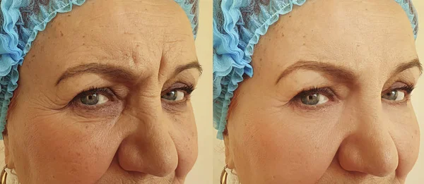 Ηλικιωμένη Γυναίκα Ρυτίδες Πρόσωπο Πριν Και Μετά Θεραπεία — Φωτογραφία Αρχείου