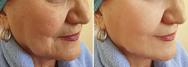Wanita Tua Keriput Wajah Sebelum Dan Setelah Pengobatan — Stok Foto