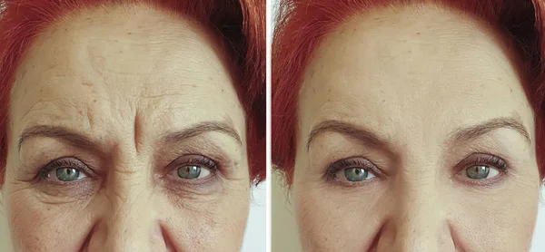 Anciana Arrugas Cara Antes Después Del Tratamiento —  Fotos de Stock