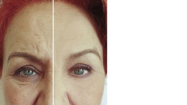 yaşlı kadın tedavi öncesi ve sonrası yüz kırışıklıkları