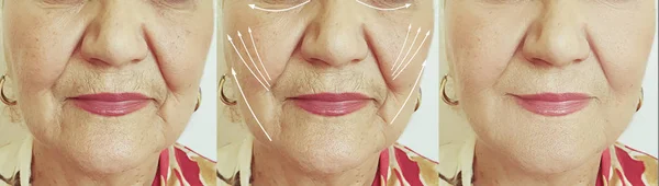 Ηλικιωμένη Γυναίκα Αντιμετωπίζουν Ρυτίδες Πριν Και Μετά Θεραπεία — Φωτογραφία Αρχείου