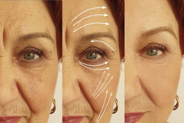 Yaşlı kadın yüz önce ve tedavi sonrası kırışıklıkları