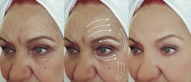 Yaşlı kadın yüz önce ve tedavi sonrası kırışıklıkları