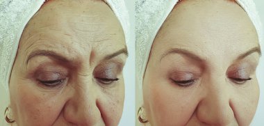 yaşlı kadın tedavi öncesi ve sonrası yüz kırışıklıkları