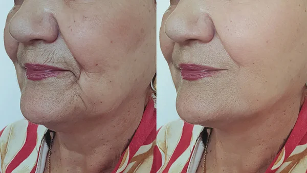 Γριά Γυναίκα Ρυτίδες Πρόσωπο Πριν Και Μετά Θεραπεία — Φωτογραφία Αρχείου