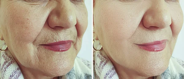 Old Woman Face Wrinkles Treatment — ストック写真