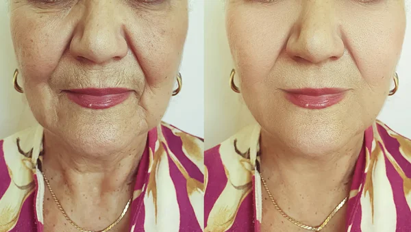 Yaşlı Kadın Tedaviden Önce Sonra Kırışıklıklarla Karşılaşır — Stok fotoğraf