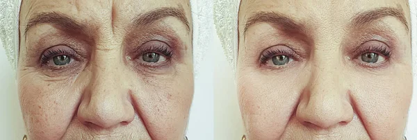Falten Gesicht Der Alten Frau Vor Und Nach Der Behandlung — Stockfoto