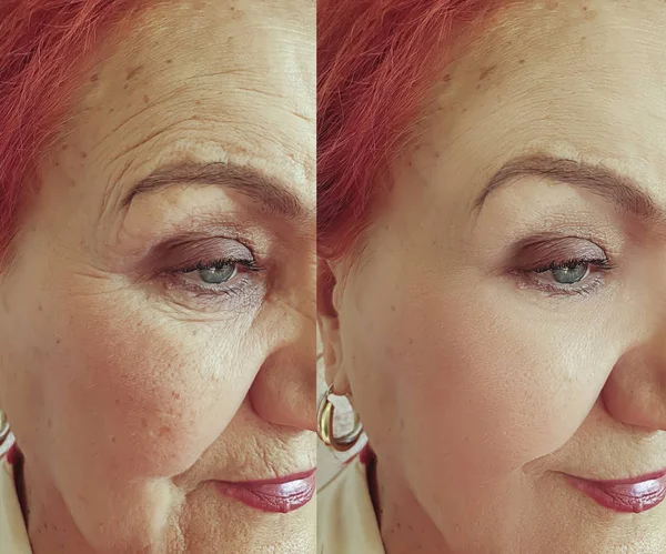 Πρόσωπο Ηλικιωμένης Γυναίκας Ρυτίδες Πριν Και Μετά Θεραπεία — Φωτογραφία Αρχείου