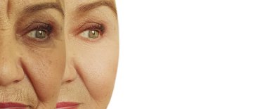 Yaşlı bir kadının yüzü tedavi öncesi ve sonrası kırışıklıklar