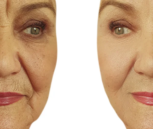 Face Elderly Woman Wrinkles Treatment — ストック写真