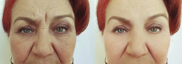 Yaşlı Bir Kadının Yüzü Tedavi Öncesi Sonrası Kırışıklıklar — Stok fotoğraf