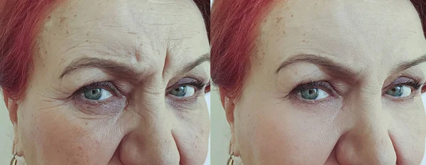 Πρόσωπο Ηλικιωμένης Γυναίκας Ρυτίδες Πριν Και Μετά Θεραπεία — Φωτογραφία Αρχείου