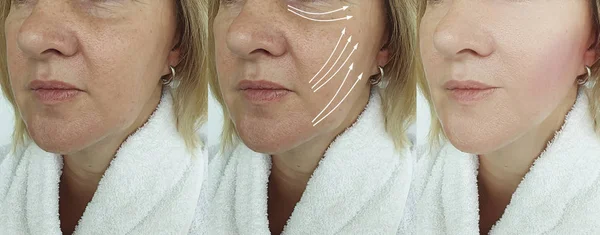 Cara Mujer Arrugas Antes Después Del Tratamiento Flecha — Foto de Stock