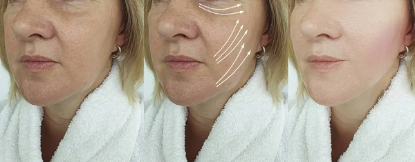 Face Woman Wrinkles Treatment Arrow — 스톡 사진