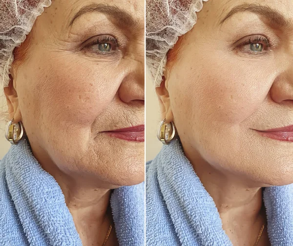 Falten Gesicht Alter Frauen Vor Und Nach Der Behandlung — Stockfoto