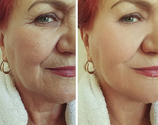 治疗前后老妇人皱纹的脸 — 图库照片