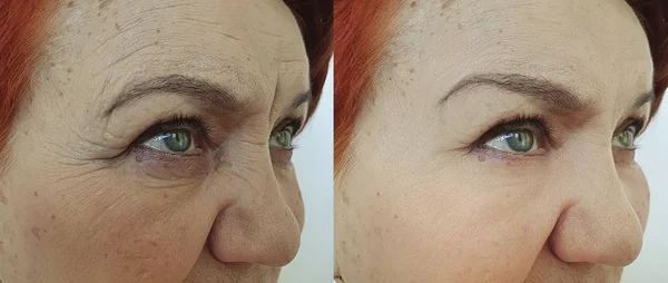 Old Woman Wrinkles Face Treatment — Stock Photo, Image