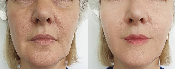 Wanita Keriput Wajah Sebelum Dan Setelah Pengobatan Dagu Ganda — Stok Foto