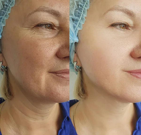Wanita Keriput Wajah Sebelum Dan Setelah Pengobatan Dagu Ganda — Stok Foto
