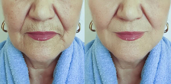Falten Gesicht Alter Frauen Vor Und Nach Der Behandlung — Stockfoto