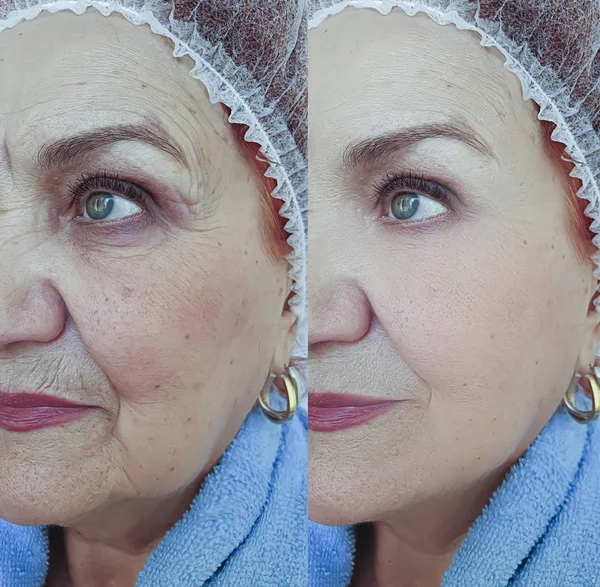Tváří Tvář Vrásky Staré Ženy Před Léčbě — Stock fotografie