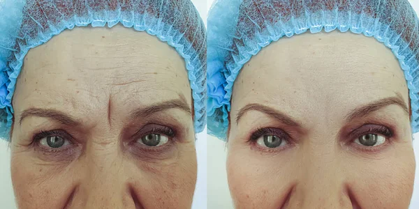 Πρόσωπο Γριά Γυναίκες Ρυτίδες Πριν Και Μετά Θεραπεία — Φωτογραφία Αρχείου