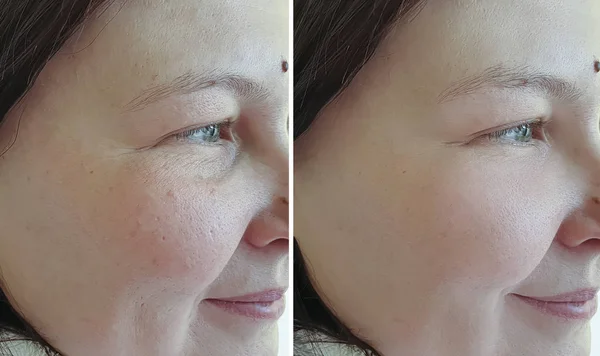 Frau Falten Gesicht Vor Und Nach Der Behandlung Pigmentierung — Stockfoto