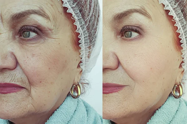 Tedavi Öncesi Sonrası Yaşlı Kadın Kırışıklıkları Yüz — Stok fotoğraf