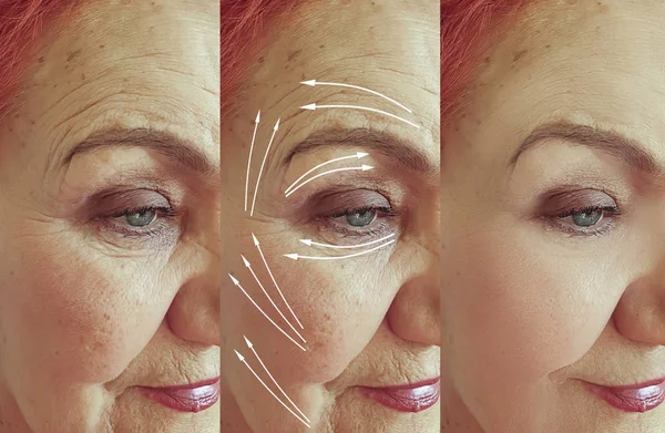老年妇女在治疗箭之前和之后面对皱纹 — 图库照片