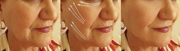 Elderly Woman Face Wrinkles Treatment Arrow — Stock Photo, Image