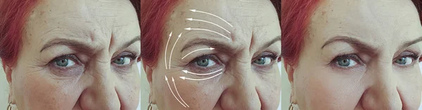 Elderly Woman Face Wrinkles Treatment Arrow — Stock Photo, Image